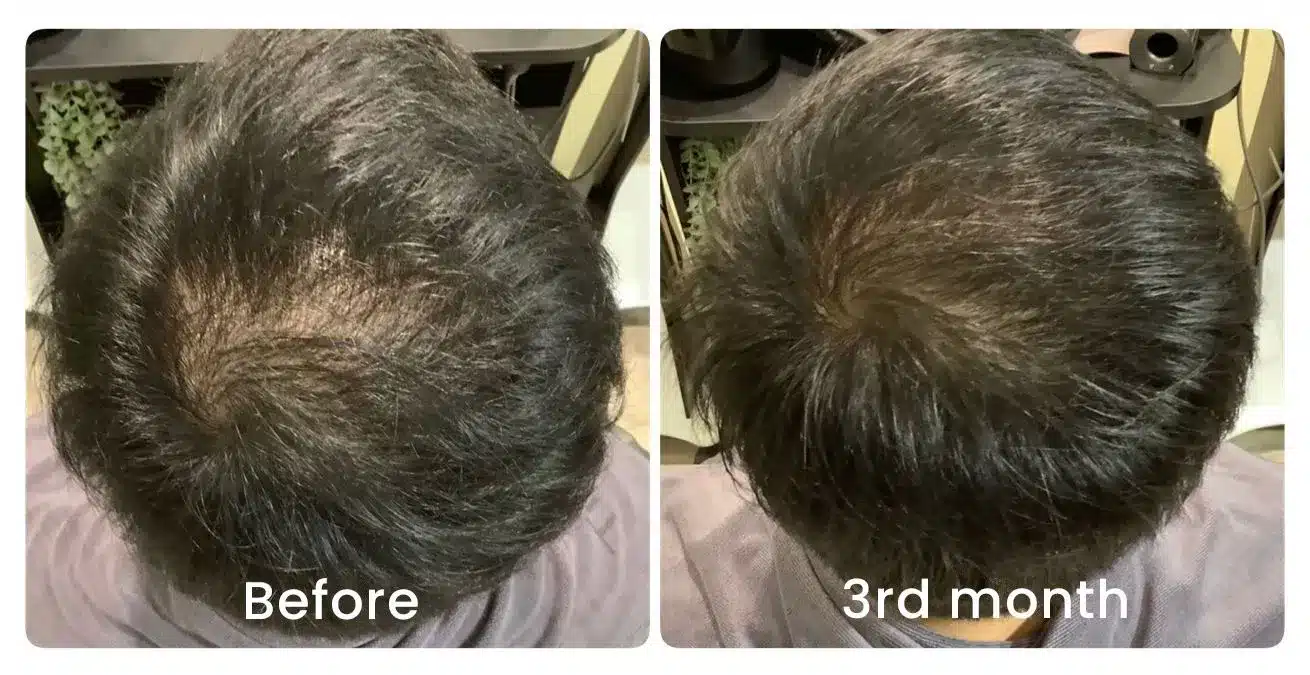 TrichoLab client — before