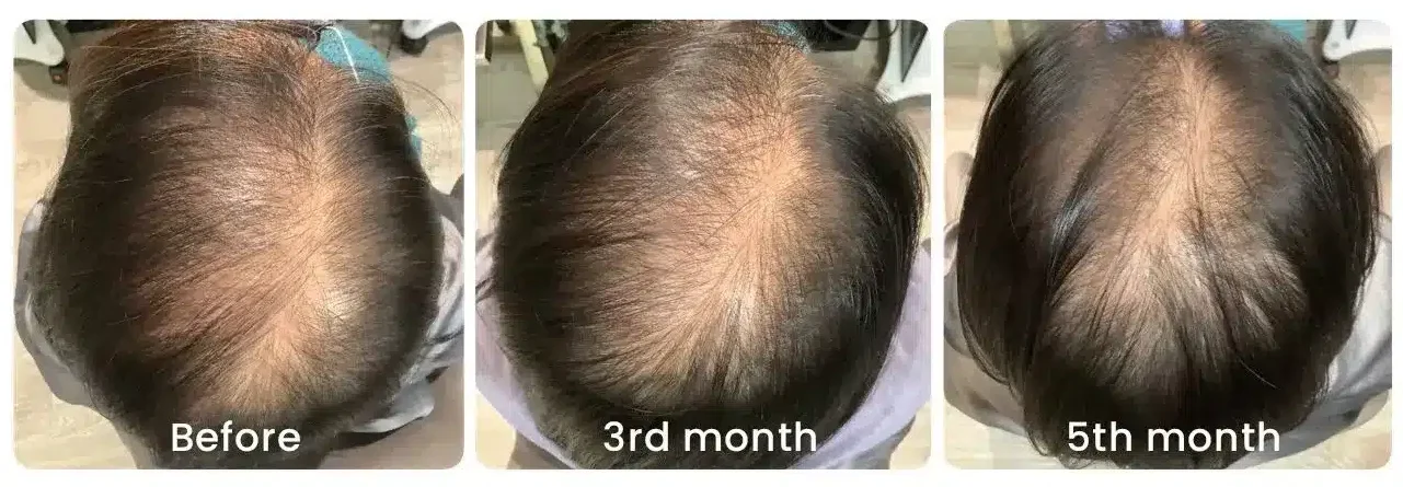 TrichoLab microneedling client — after