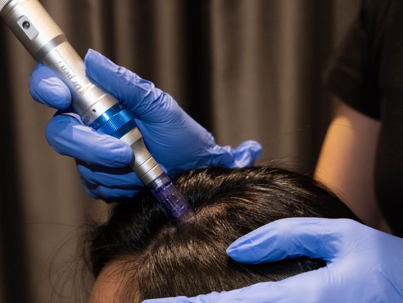 Medical microneedling pen on the scalp
