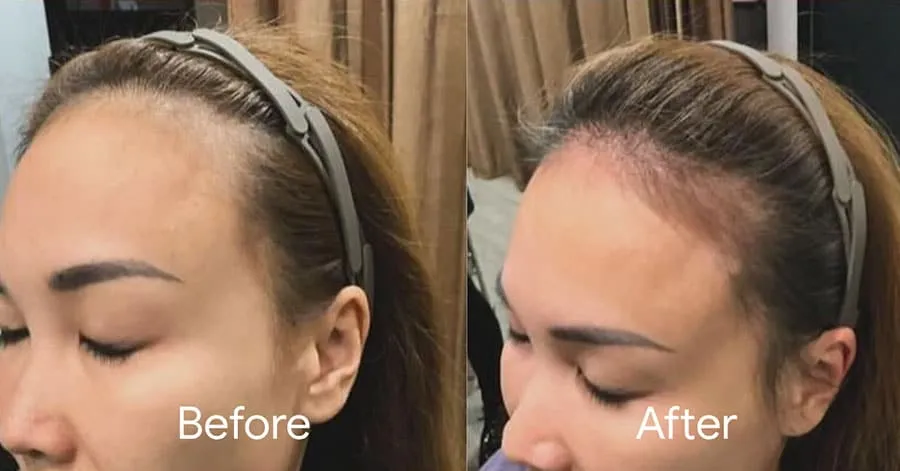 Two panels comparing a client's hairline before and after treatment, showing reduced visible scalp along the front